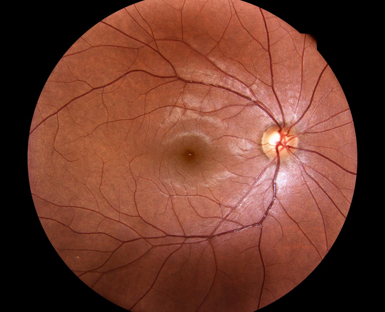 Glaucome